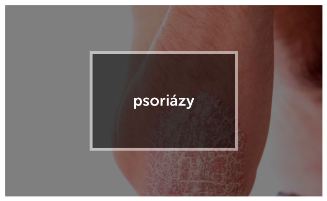 Psoriaza